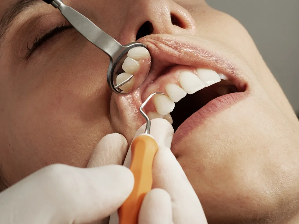 Dentist performing a dental cleaning. Photo by <a href='https://unsplash.com/@carocaro1987'>Caroline LM</a> on <a href='https://unsplash.com/photos/8BkF0sTC6Uo'>Unsplash</a>